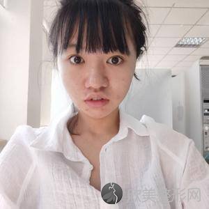 呼和浩特德尔美客蕊儿医疗美容门诊部钱蕊做下巴吸脂术怎么样？附医生简介