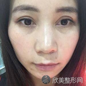肪也没有了，手术中倒是还好，没有什么感觉。激光去黑眼圈整形案例术中身边很多的朋友，因为有时工作时间会不定时，睡眠也不好，还有经常熬夜