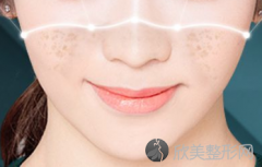 激光祛斑大概是的价格是多少