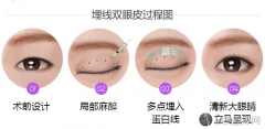 衡阳哪里做埋线双眼皮比较好