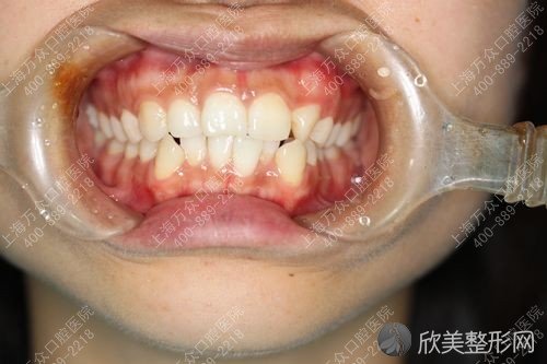 牙齿矫正 小孩牙齿畸形牙难看 要“火速牙齿矫正”