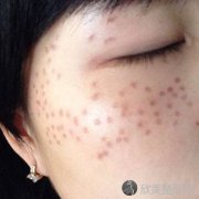 广州做激光祛斑治疗后过多长时间才可以洗脸呢