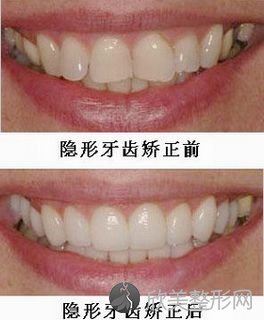 青少年暑期做牙齿矫正多少钱 <a href='https://www.joshreso.com/project/859.html' target='_blank'><u>隐形矫正</u></a>效果图