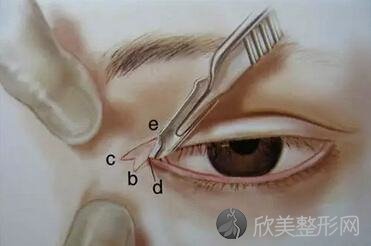 广州做眼睛开眼角手术要多少钱呢