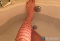 广州做激光脱腿毛需要注意哪些细节呢