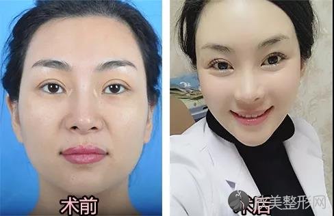 广州有什么好方法可以给脸部凹陷进行填充呢