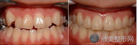 牙齿排列不齐做隐形矫正有什么优势