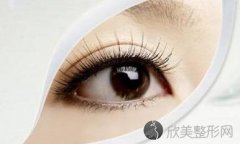 广州做眼睛整容双眼皮术后恢复快吗
