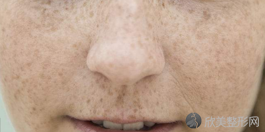 女性脸上的雀斑消除的方法