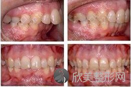 成人龅牙牙齿矫正常见方法