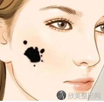 广州做完激光祛斑之后脸上会留下结痂吗