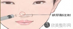 长沙美莱玻尿酸隆鼻效果好不好