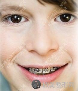 儿童做牙齿矫正费用要多少