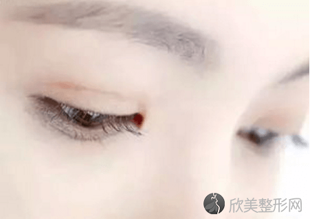 在武汉美莱做全切双眼皮手术大致过程
