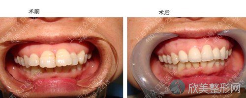上海矫正牙齿多少钱