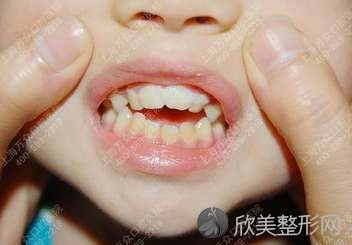 儿童牙齿畸形的原因