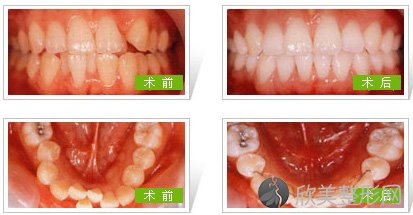 患者咨询：牙齿正畸期间可以抽烟吗
