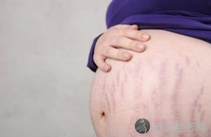 广州做激光去妊娠纹手术安全吗