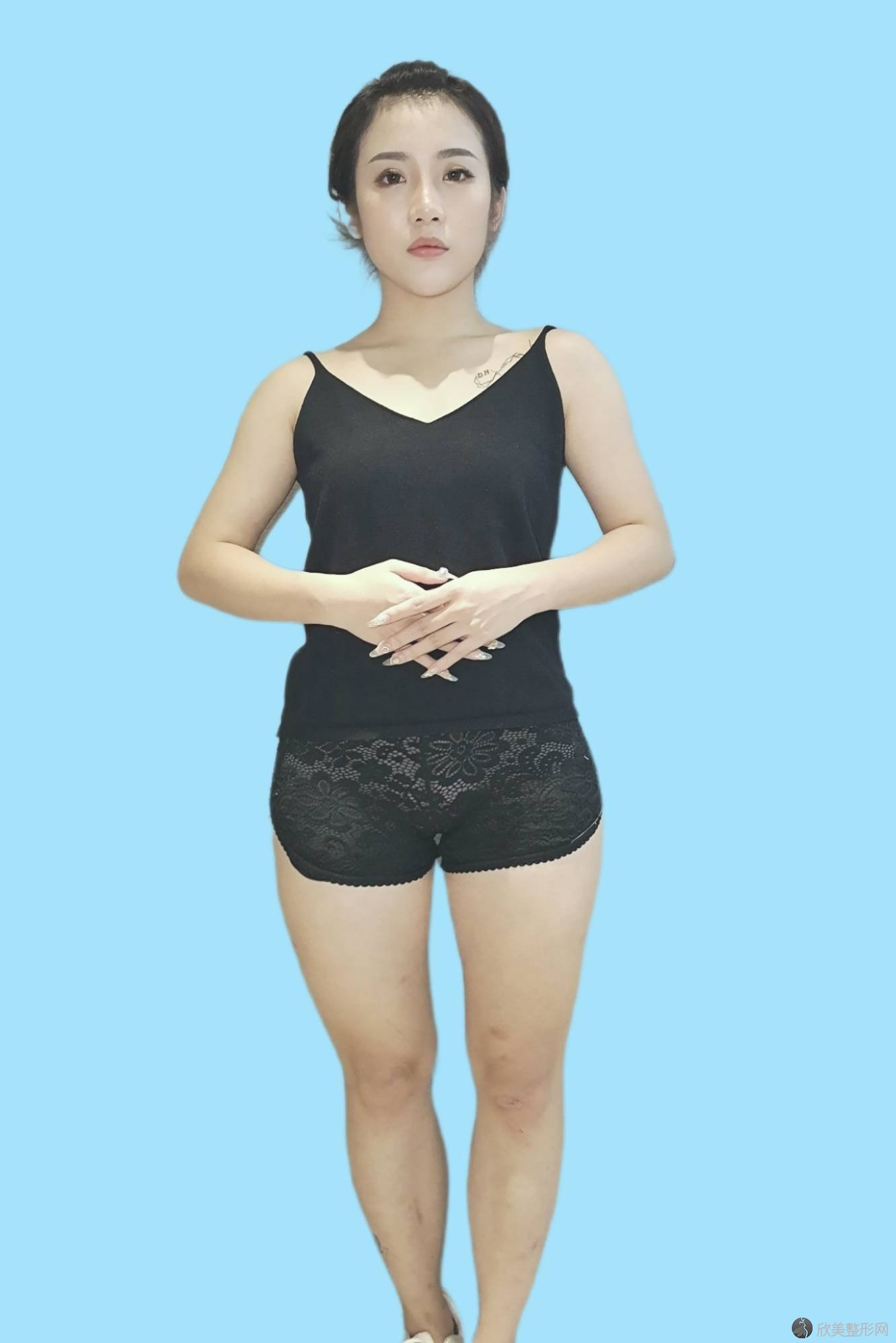 重庆三峡中心医院百安分院烧伤整形外科汪洋做吸脂瘦大腿怎么样？附医生简介