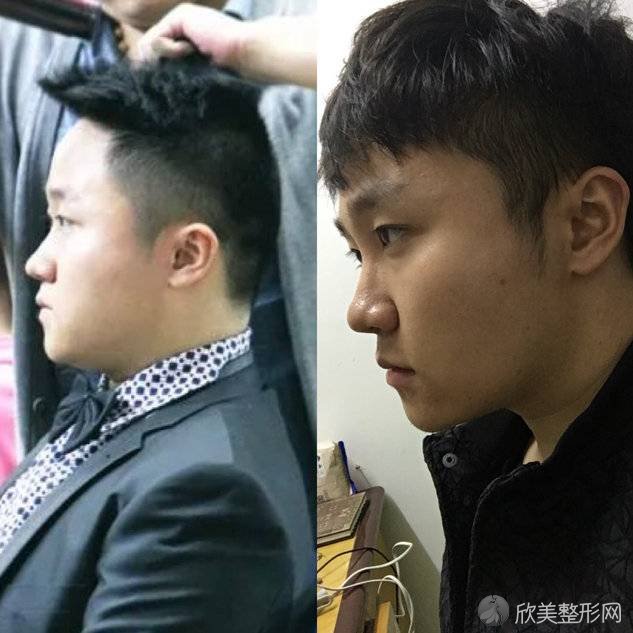 沈阳哪家医院做注射瘦脸效果比价好？排名前五口碑医院盘点-沈阳华美医院、