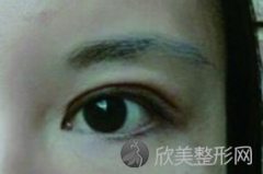 深圳哪家医院做双眼皮失败修复效果好呢