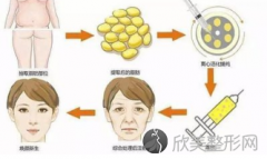 广州注射玻尿酸面部填充好吗