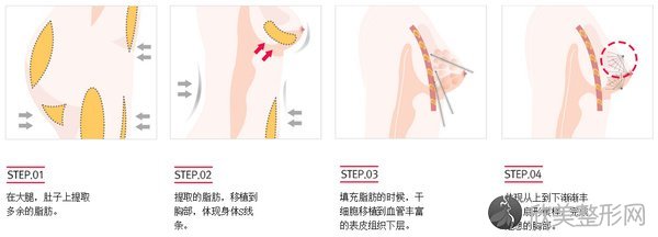 广州自体脂肪隆胸手术安不安全