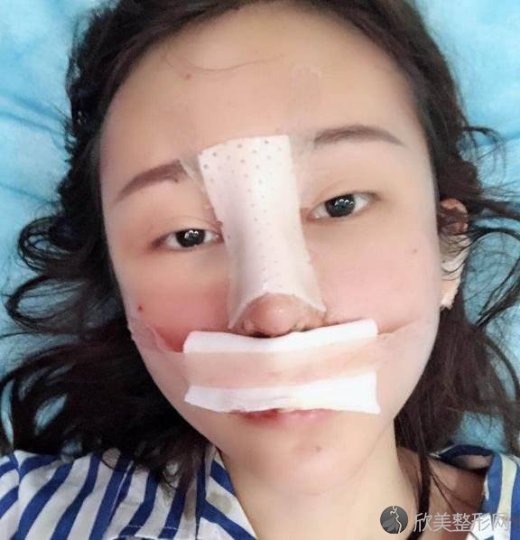 韩国丽儿整形高应烈做自体脂肪面部填充怎么样？附医生简介-自体脂肪面部填