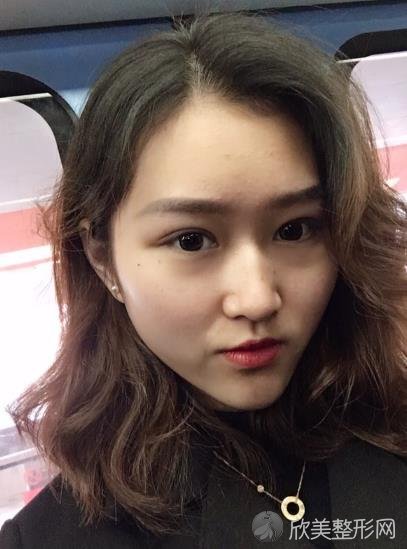 哈医大一院美容整形究竟怎么样？内附较新整形价格表及热玛吉案例分享