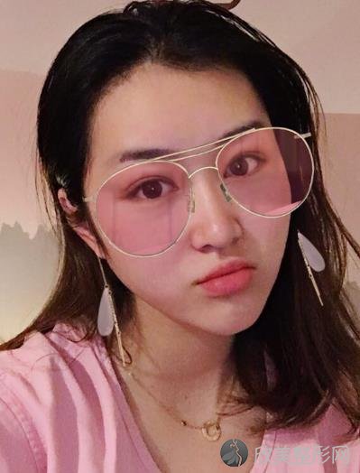 哈医大一院美容整形究竟怎么样？内附较新整形价格表及热玛吉案例分享