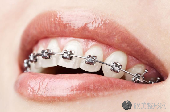 牙齿带过牙套可以做牙齿矫正吗