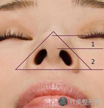鼻小柱整形方法有哪些?内附鼻小柱整形优势分享