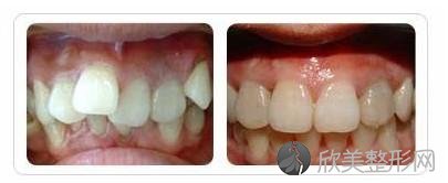 福建导致孩子牙齿错颌畸形的原因是什么