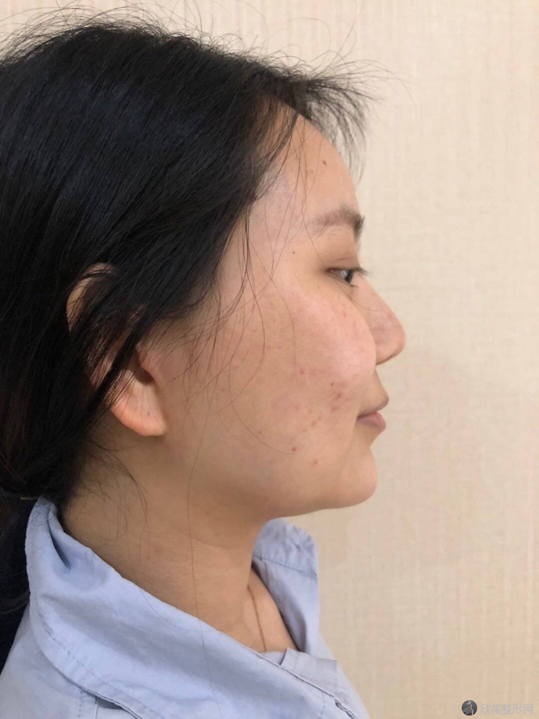 中年妇女整容手术前的笑脸特写。皮肤护理皱纹的脸。前后抗衰老拉皮治疗。面部皮肤护理和轮廓。照片摄影图片_ID:398752298-Veer图库