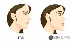 反颌矫正手术费用