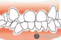 矫正牙齿要换几次钢丝