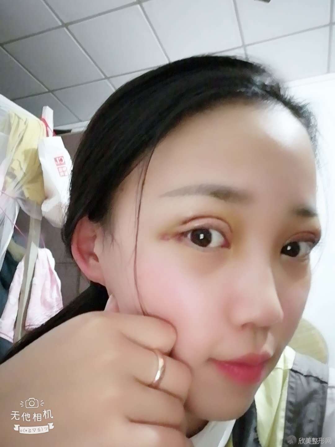 驻马店哪家医院做定点双眼皮好？排名列表公布!除美菲尔还有爱度、雅坤卫红