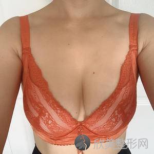 邯郸雅乾皮肤外科整形医院刘红艳做自体脂肪填充隆胸怎么样？附医生简介-自