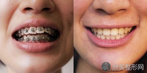 牙齿矫正是否会影响脸型呢