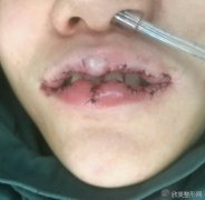 南阳卫生学校附属医院整形外科刘建明M唇手术效果怎么样_术后160天前后照对比