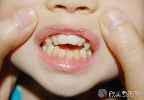 未成年应该处理的畸形牙齿