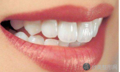 牙齿保持器价格