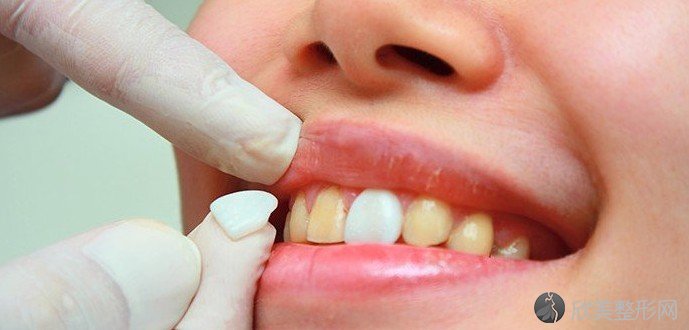 治疗氟斑牙多少钱呢