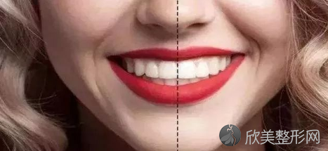 牙齿稀疏能矫正吗