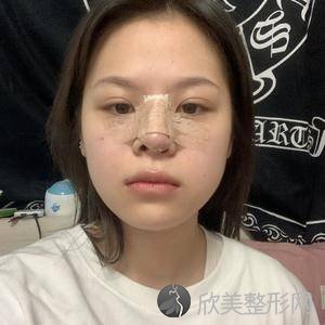亳州哪家医院做鼻综合整形手术好？2020-还有整鼻综合整形价格案例参考哦!！