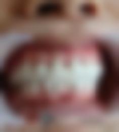 北京维尔口腔医院牙齿整形后