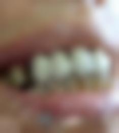 北京维尔口腔医院牙齿整形前
