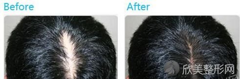头发稀疏裸露头皮，哈尔滨的加密植发技术咋样，能改善吗？