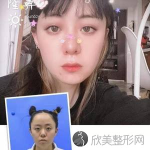 鞍山哪家医院做自体软骨隆鼻好看？排名前三唐龙、海城田医生、含山县妇幼保