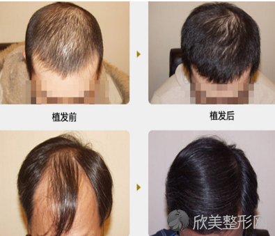 哪些人不适合头发种植呢？天津下调发际线医院做的靠谱吗？